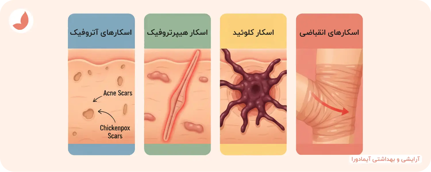 انواع اسکار