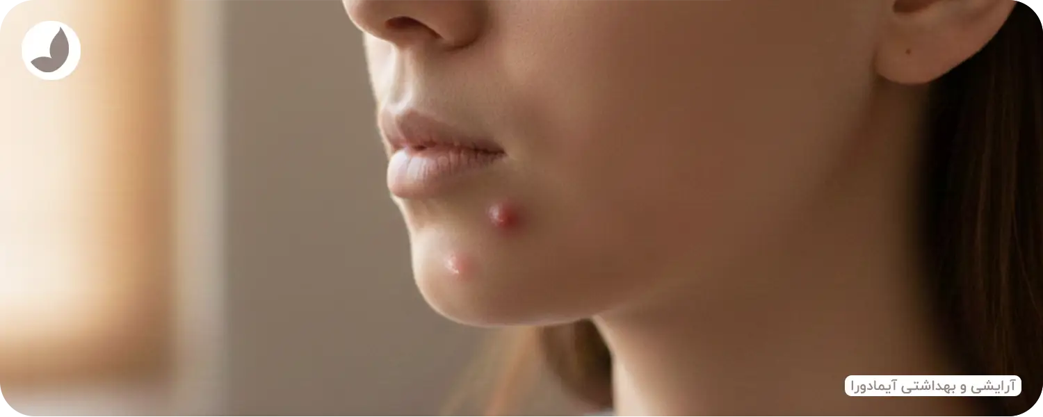 درمان جوش چانه