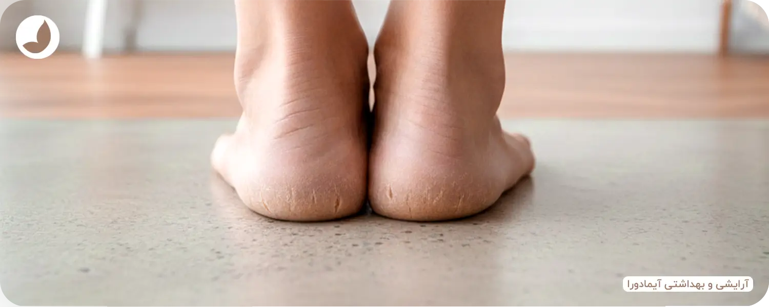 درمان کرم ترک پا