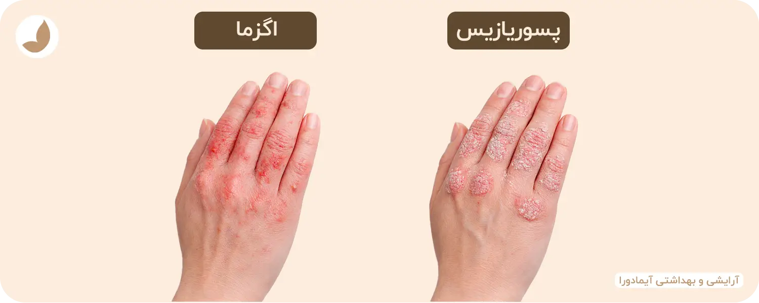 تفاوت پسوریازیس با اگزما