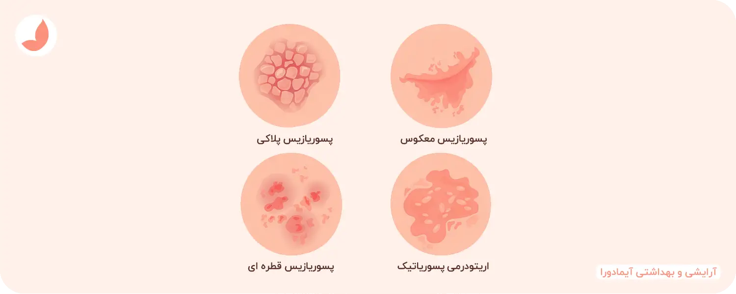 انواع پسوریازیس