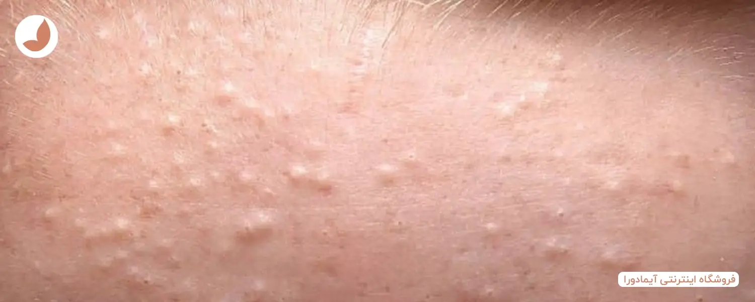 چطور میتوانیم جوش های زیر پوستی را درمان نماییم؟ 