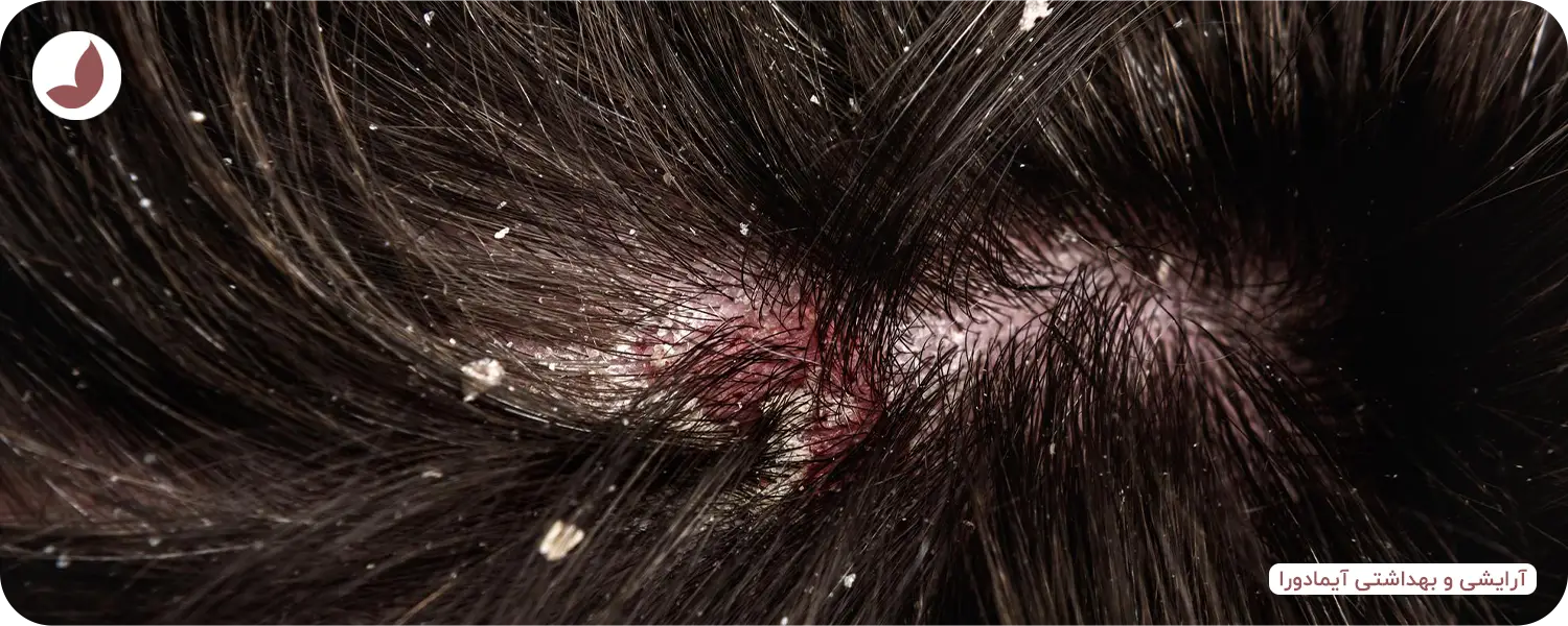 شامپو کتوکونازول برای شوره سر