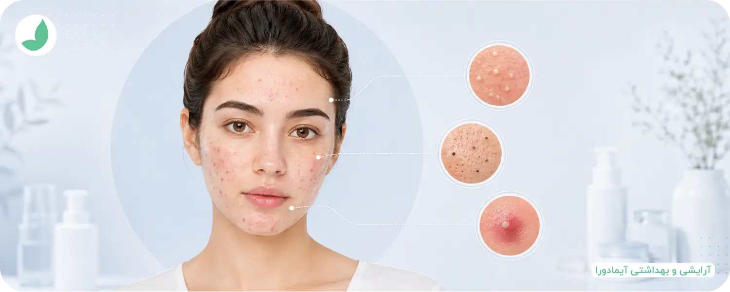What Is Acne 02