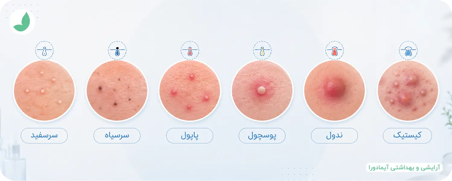 انواع جوش صورت