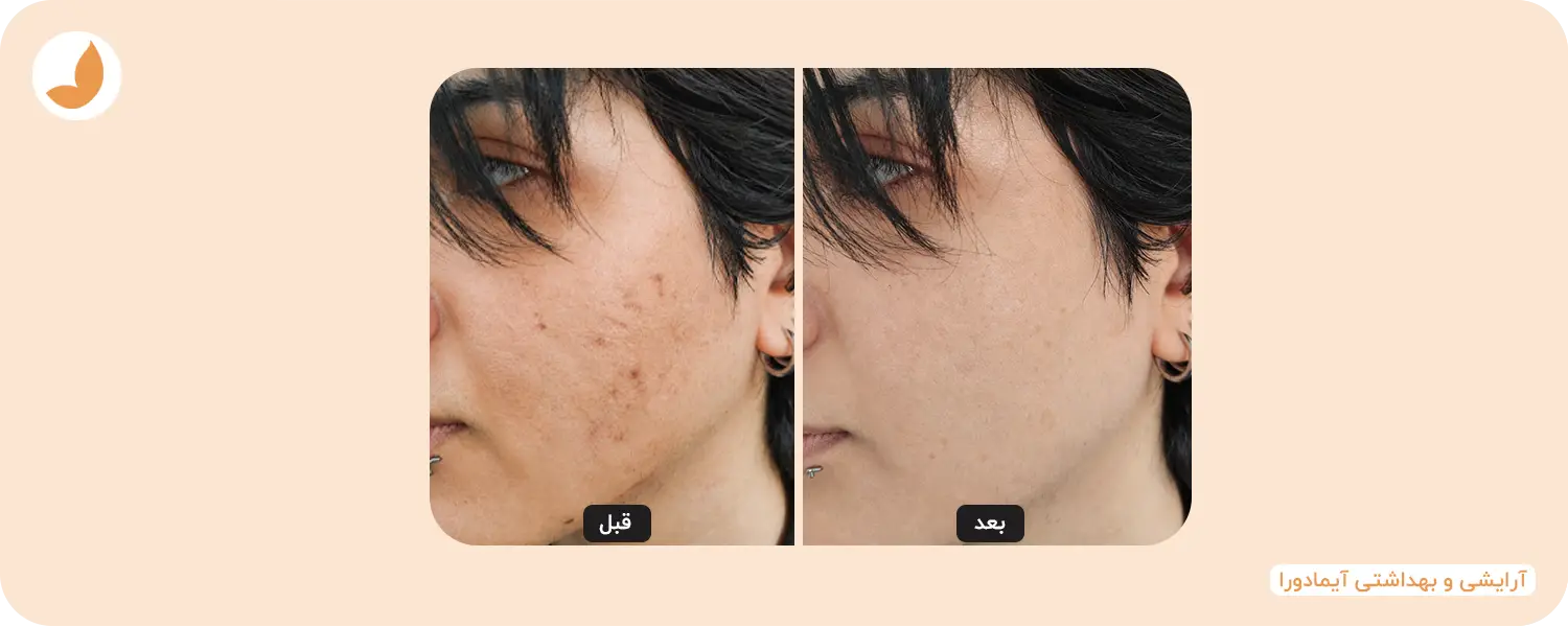 بهترین کرم ترمیم کننده جای جوش